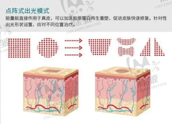 视频告诉你点阵激光可以治疗哪些皮肤问题：痤疮/疤痕/雀斑/细纹等