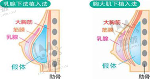 隆胸手术