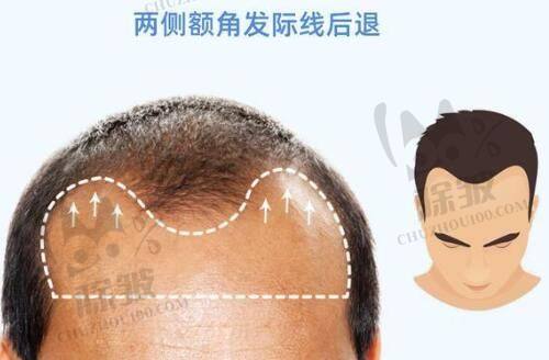 七台河整形美容医院中的双燕埋线双眼皮项目