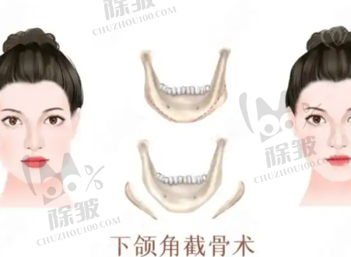 还不知道揭阳整形医院的去眼袋项目如何，华美整形有优势