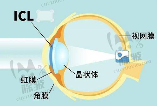 2025昆明红会眼科医院全飞秒手术优势