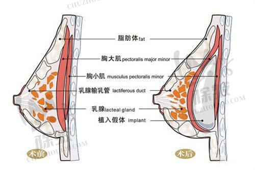 崔鑫医生的腹壁成形技术特色鲜明