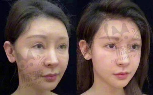 北京王阔远医生面部减容收费情况