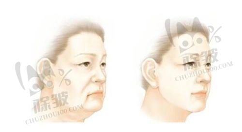 黄寺整形美容医院院长杜太超医生小拉皮手术的个性化设计