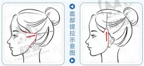 2025北京比较靠谱的整容医院中的脂肪填充项目