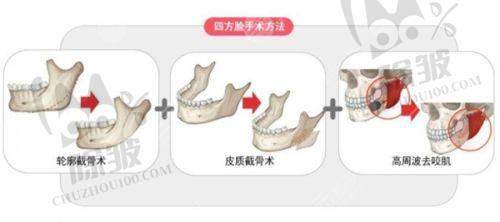 吉林大学第(一)医院整形美容外科面部轮廓项目价格表