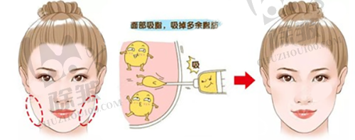 选择乔雅登型号的建议