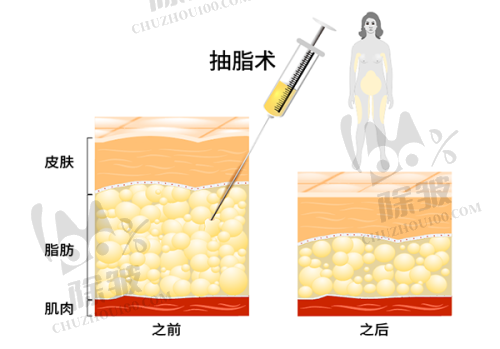 乔雅登2号适应部位及特点