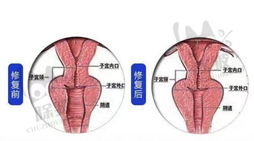 菲林普利隆鼻自然不透光