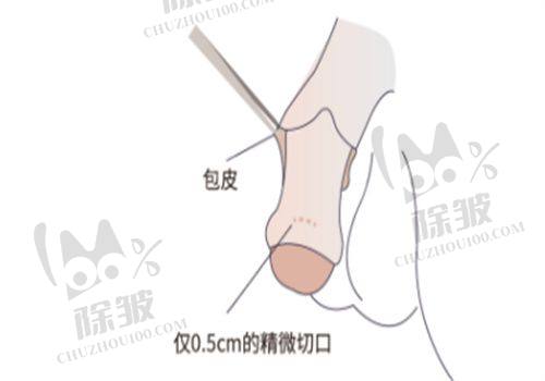 影响疤痕修复费用的其他因素