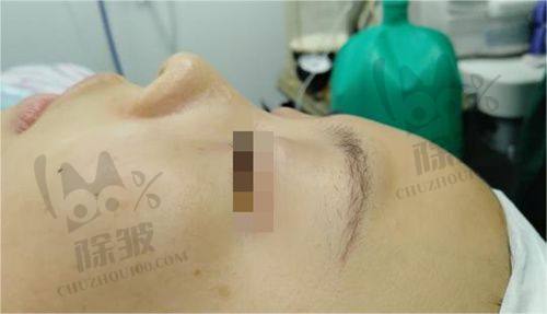 兰大一院整形科2025鼻部整形项目价格