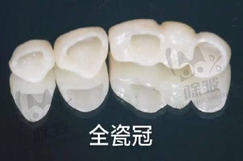 2025北京劲松口腔医院种植牙收费详情