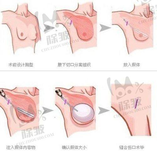 菲林普利隆鼻的安心性