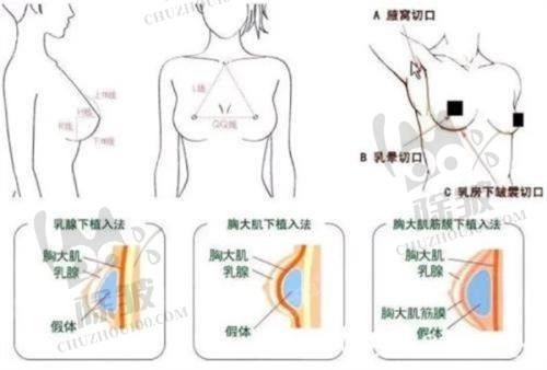 武汉其他医院的乳房提升项目