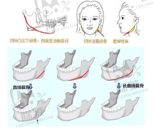 如何选择适合自己的疤痕修复医院和方案