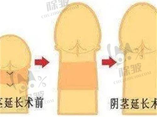 武汉华美付国友拉皮手术改善部位