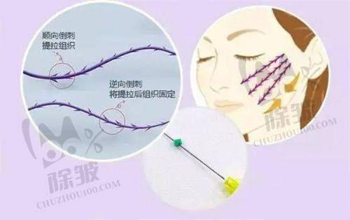 菲林普利隆鼻 L 型支撑力强