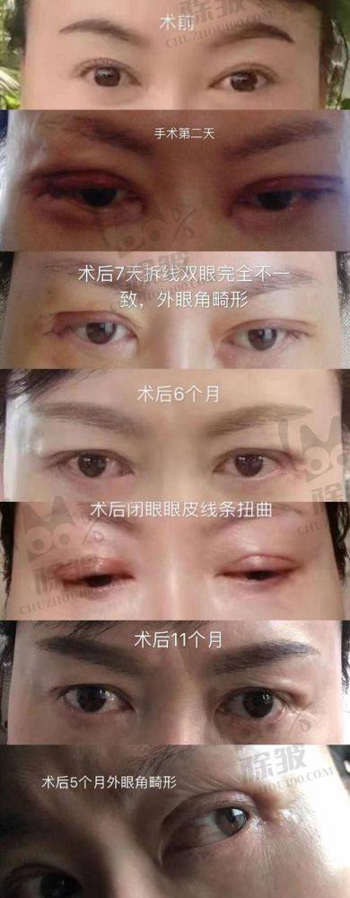 刘志刚医生修复双眼皮的技术实力如何