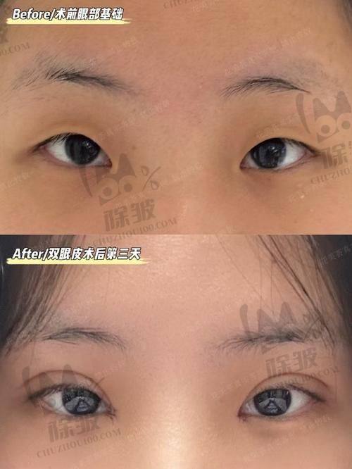大连爱德丽格王鹤霏医生的明星眼整形方法论揭秘