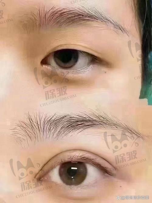 大连爱德丽格王鹤霏双眼皮手术的三维美学设计亮点