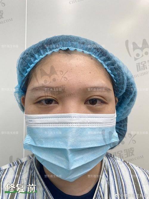 刘志刚医生修复双眼皮的患者口碑好不好