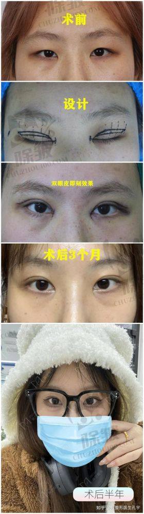 刘志刚医生修复双眼皮的行业地位怎么样
