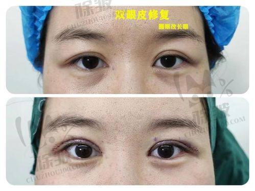大连爱德丽格王鹤霏双眼皮手术的并发症防控体系保护