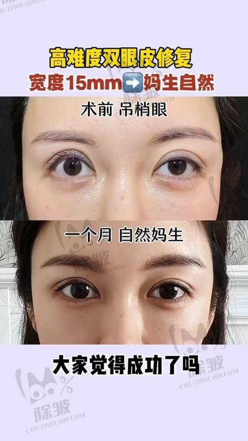 大连爱德丽格王鹤霏双眼皮手术的性价比优势凸显