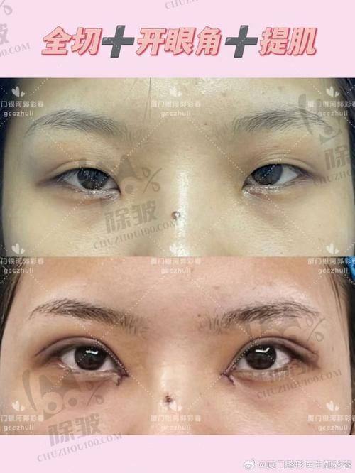 刘志刚医生修复双眼皮的价格与性价比情况如何