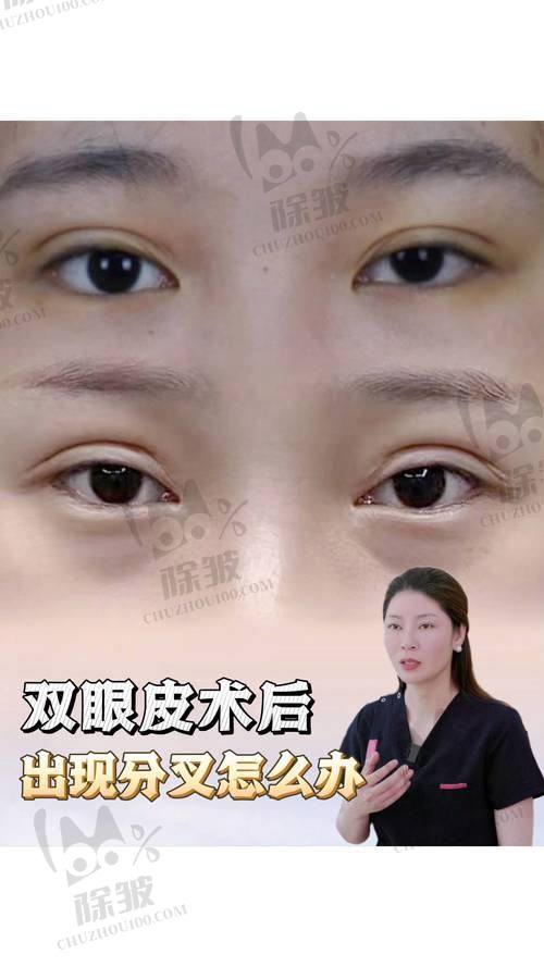 大连爱德丽格王鹤霏双眼皮手术的微创精细化操作优势