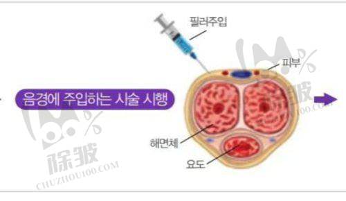 哈尔滨羽禅医疗美容医院韩国锁恩爱女性私密薇旖美极纯Ⅲ型项目推荐医生及技术优势