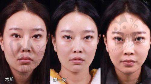 蔡圣民医生黄金微针的治疗优势
