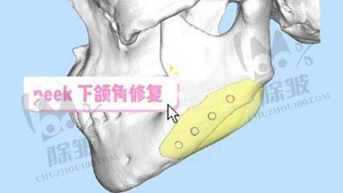 曝光黄金微针射频仪器虚假宣传骗术