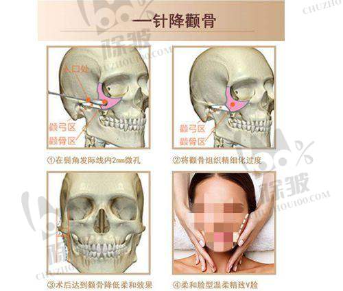 3DEEP黄金微针之缩小毛孔