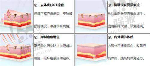 3DEEP黄金微针之皮肤修复与重建