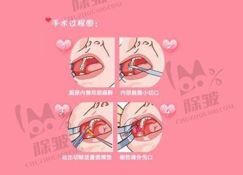 曝光黄金微针射频发数不足骗术