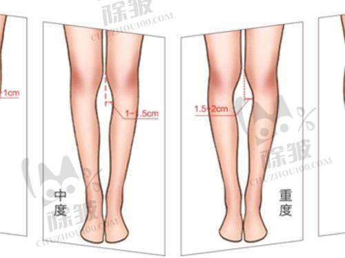 杭州整形医院谭晓燕医生隆鼻特色