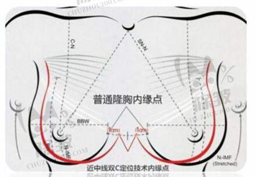 杭州薇琳吸脂手术实例分享