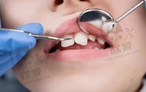口腔治疗项目科普