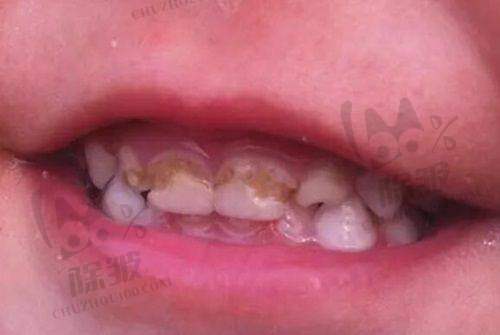 西安牙贴面科普知识