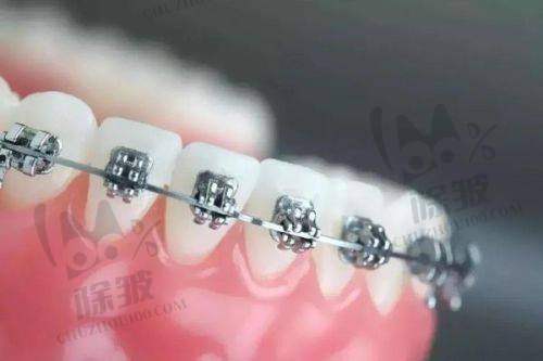 卡尔斯种植体宿玉成之研发历程