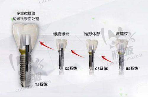 卡尔斯种植体宿玉成之临床应用