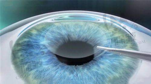 杭州黑马眼科综合优势铸就优质诊疗