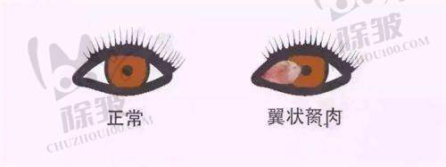 上海医大医院眼科不同手术方式对比