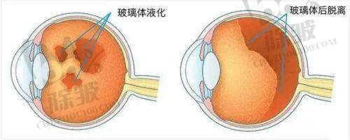 深圳光爱眼科角膜塑形镜服务