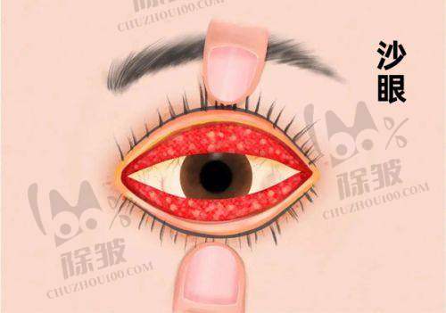 上海医大医院眼科近视手术具体价格项目