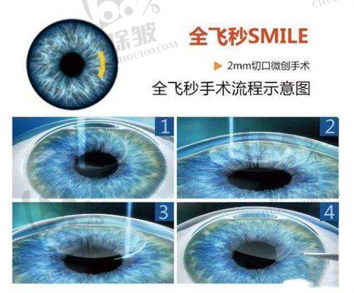 杭州黑马眼科医生团队实力超群
