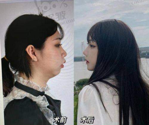 利用饮食调节减男性雌化胸