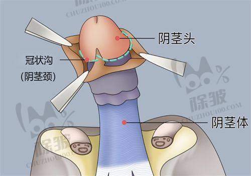 考虑手术减男性雌化胸