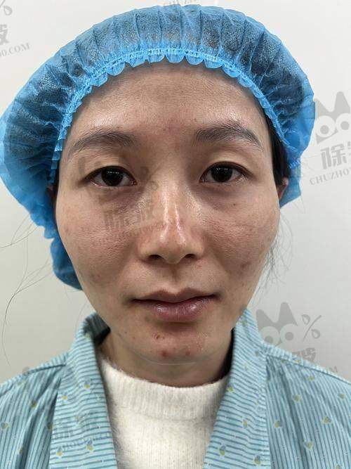 昆山容妍整形柴云医生口碑评价及真人实例